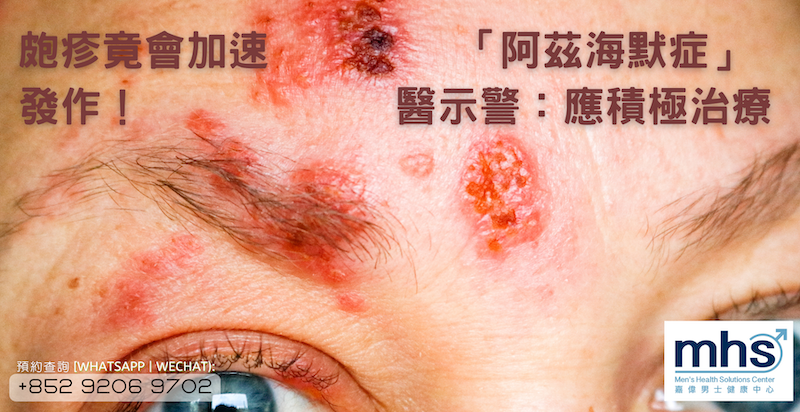 性病 | 皰疹竟會加速「阿茲海默症」發作！醫示警：應積極治療